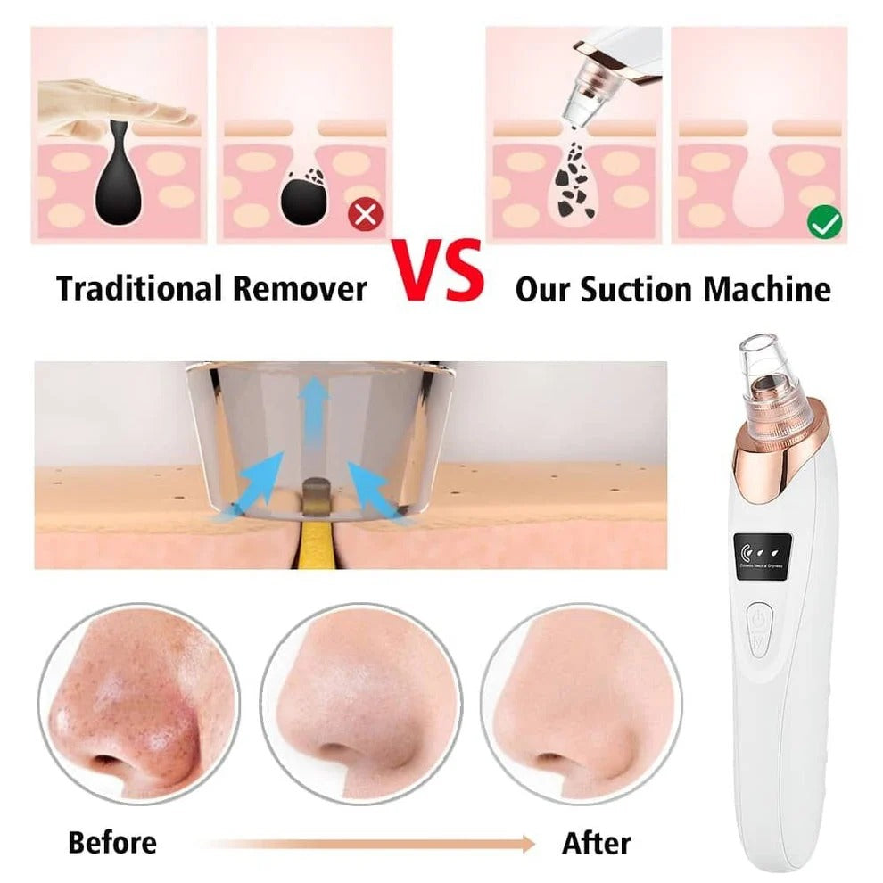 Electric Blackhead Remover Machine – Deep Pore Cleaner & Facial Suction Vacuum