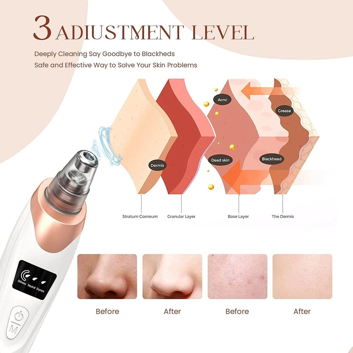Electric Blackhead Remover Machine – Deep Pore Cleaner & Facial Suction Vacuum
