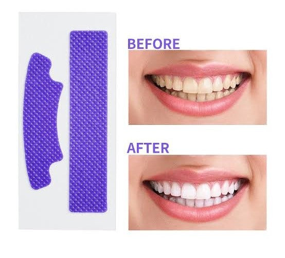 Teeth Whitening Strips – At Home Teeth Whitening Treatment