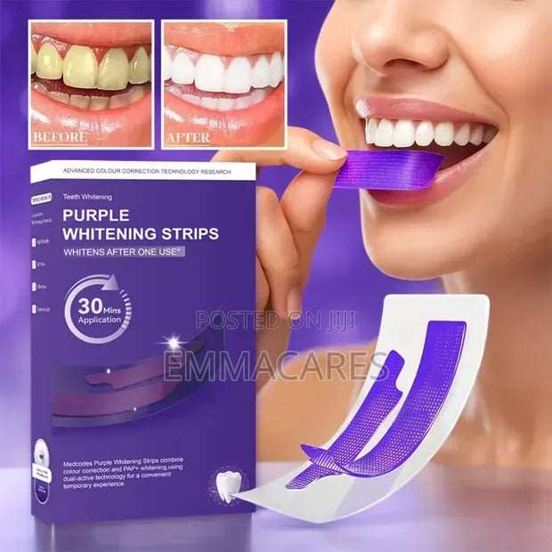 Teeth Whitening Strips – At Home Teeth Whitening Treatment